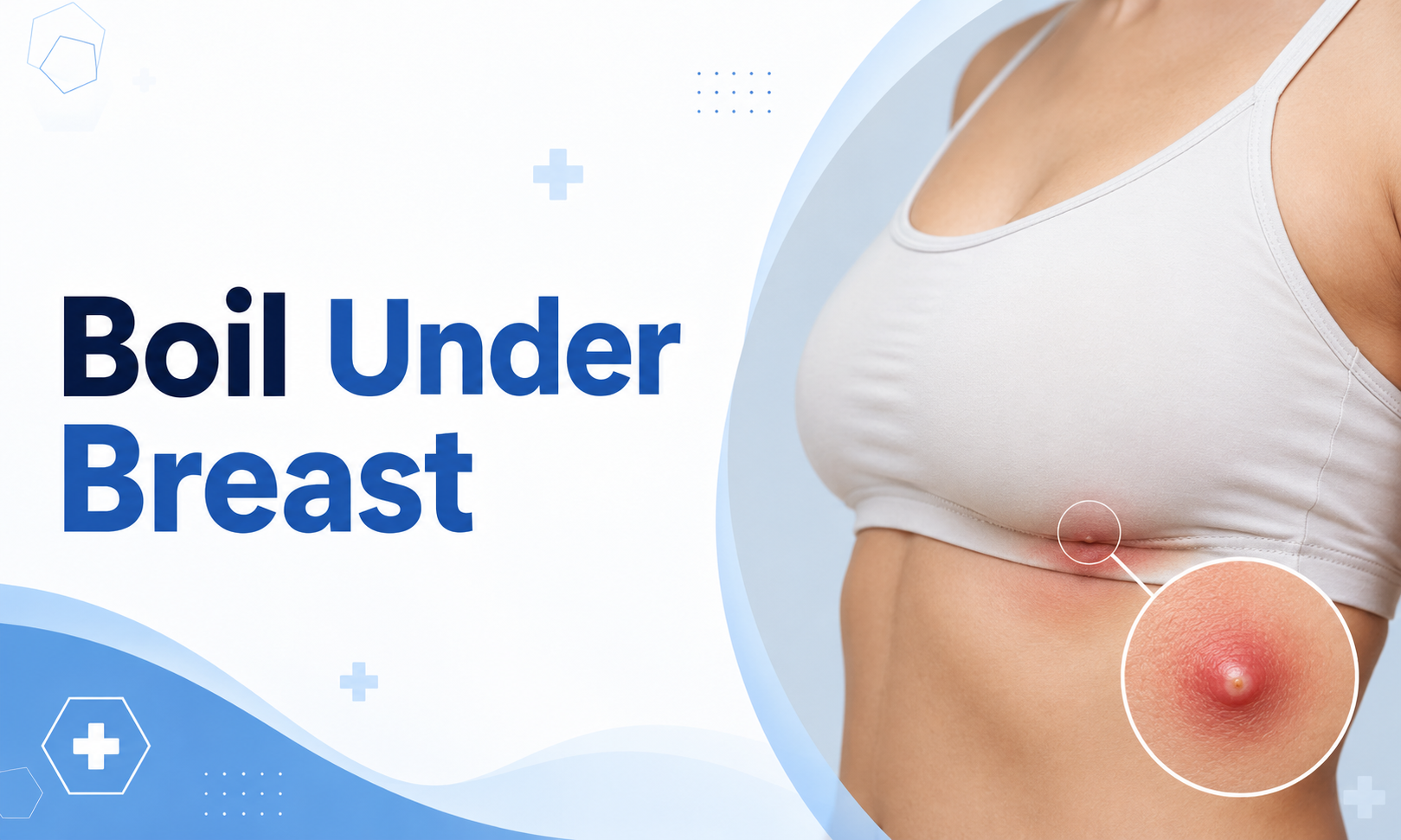boil under breast